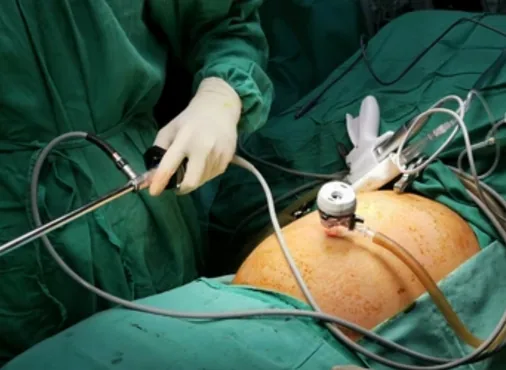Cholecystectomy - Laparoscopic Gallbladder Removal consultation at Niraaya Hospital